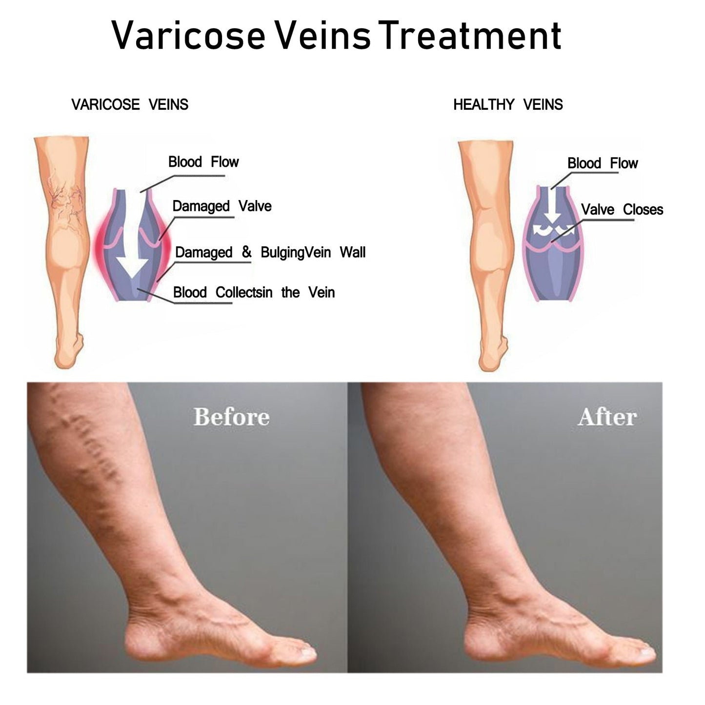 EELHOE vein massage cream relieves varicose veins and relieves pain caused by raised blood vessels in the legs 