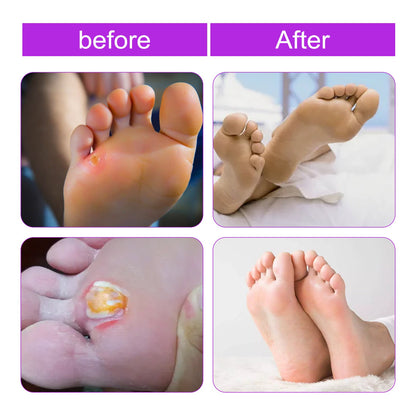 South Moon corn removal solution, especially for removing corns, skin care, calluses, foot pads and warts 