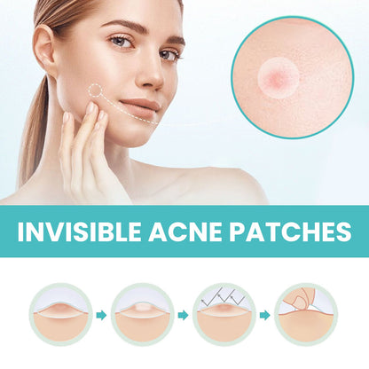 West&amp;Month acne patch repairs acne and blackheads, cleans pores, invisible, breathable, concealer, waterproof, acne-clearing patch 