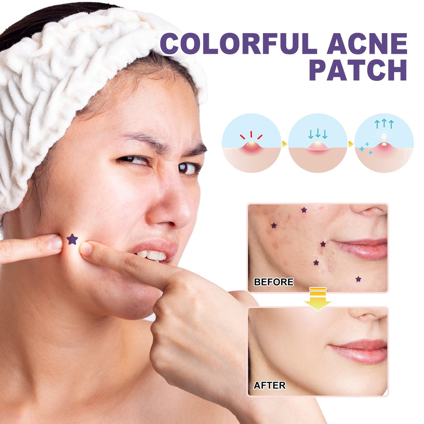 Hoygi purple acne patch repairs acne and blackheads, mild and non-irritating, smooth skin, acne-clearing patch 