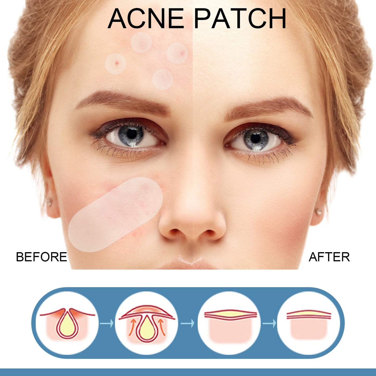 EELHOE Acne Patch Invisible Acne Cleansing Patch Anti-acne Closed Acne Waterproof Makeup Concealer Hydrocolloid Oil Acne Patch 