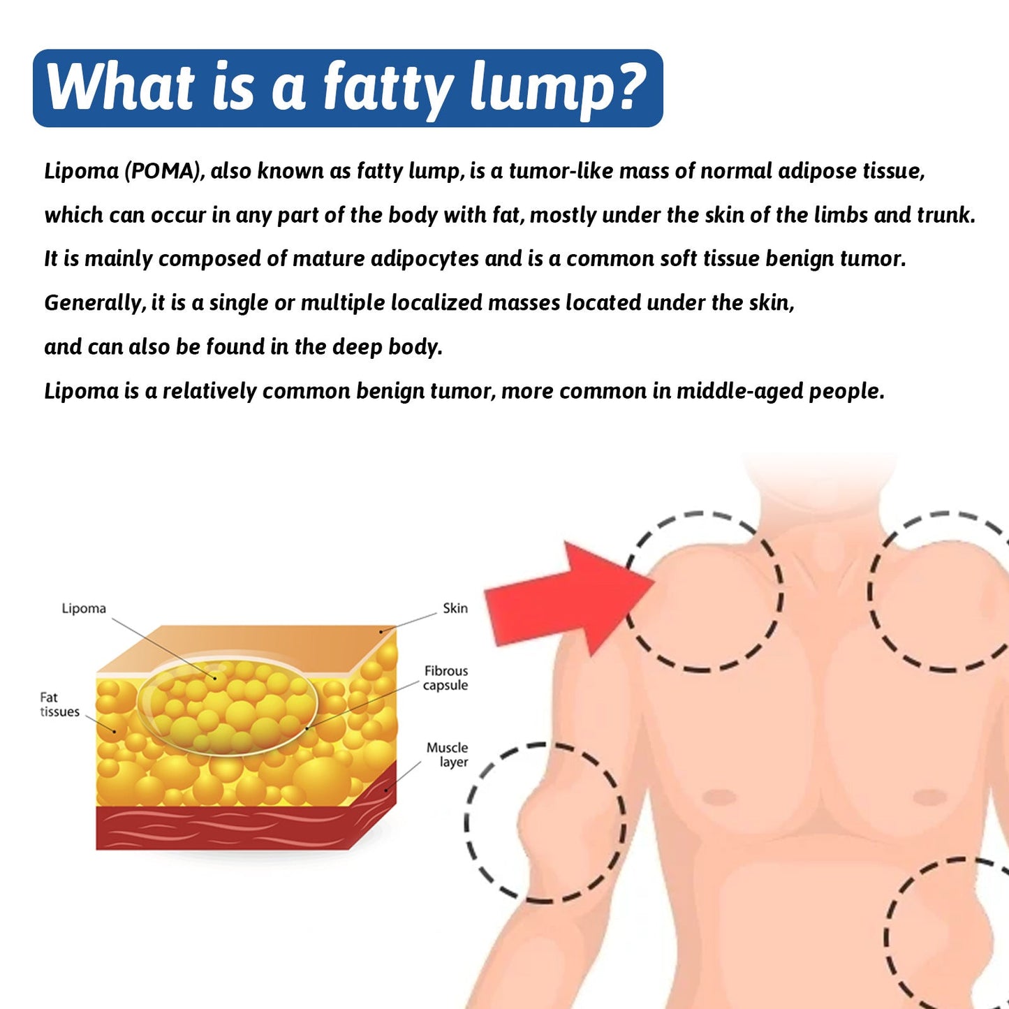 South Moon fat knot cream improves fat cream relieves fat lumps and hard lumps and tumor removal cream 