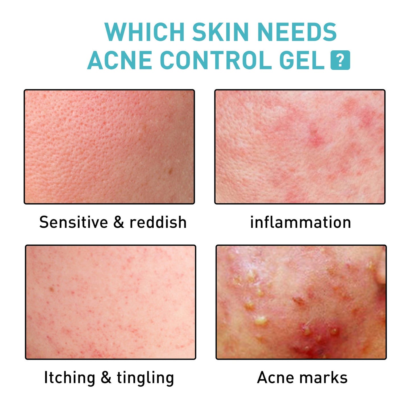 Jayusing Acne Repair Gel បំបាត់ស្នាមមុន ស្នាមមុន ជួសជុល ផ្តល់សំណើម និងធ្វើអោយស្បែកភ្លឺថ្លា។ 