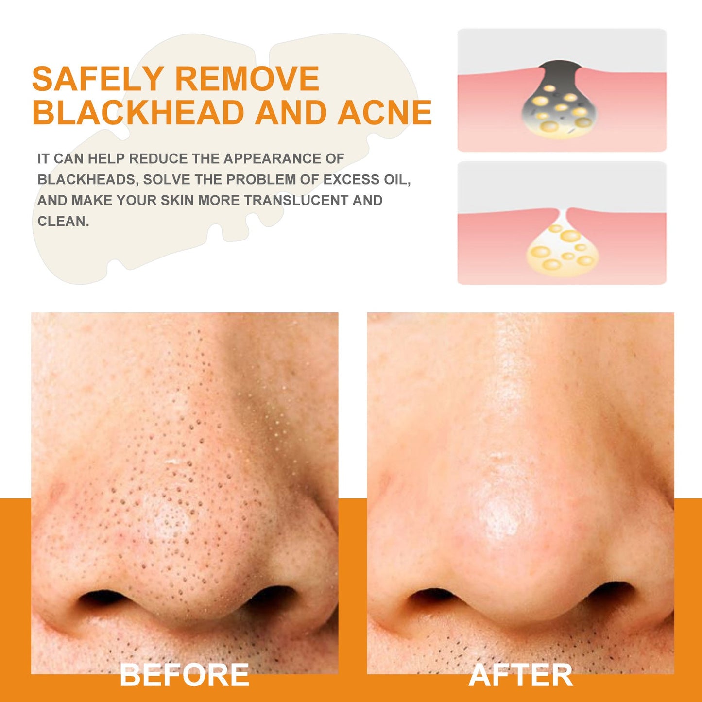 West&amp;Month blackhead ថ្នាំបំបាត់មុនក្បាលខ្មៅ បំបាត់មុនក្បាលខ្មៅ មុនអង្កាម សំអាតរន្ធញើស និងភាពកខ្វក់បានជ្រៅ បំបាត់ស្នាមសង្វារ 