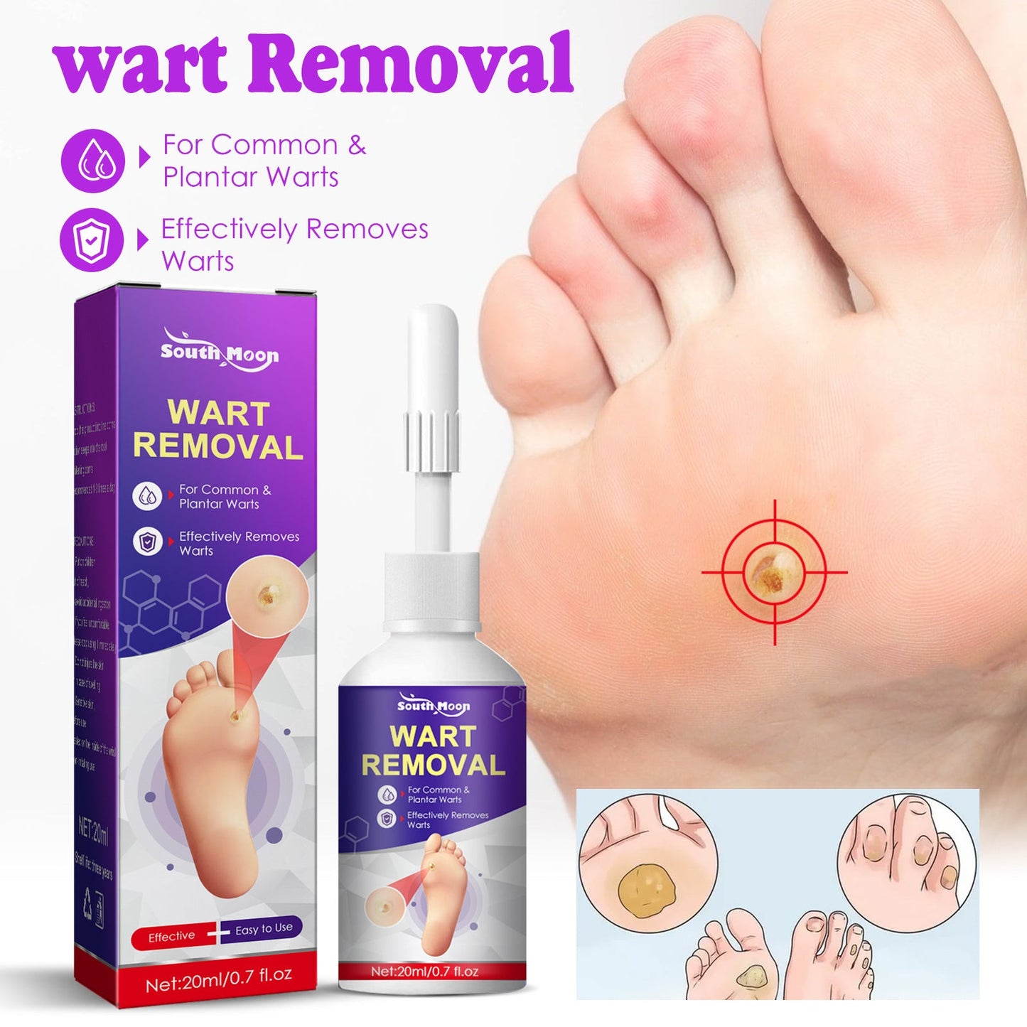 South Moon corn removal solution, especially for removing corns, skin care, calluses, foot pads and warts 