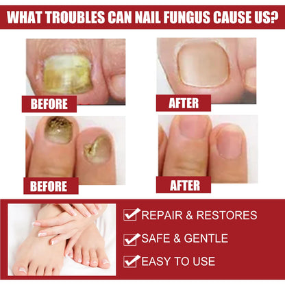 ដំណោះស្រាយជួសជុលក្រចក EELHOE Nail Care Hands and Feet Nail Repair Moisturizing Cleansing Onychomycosis Nail Repair Solution 