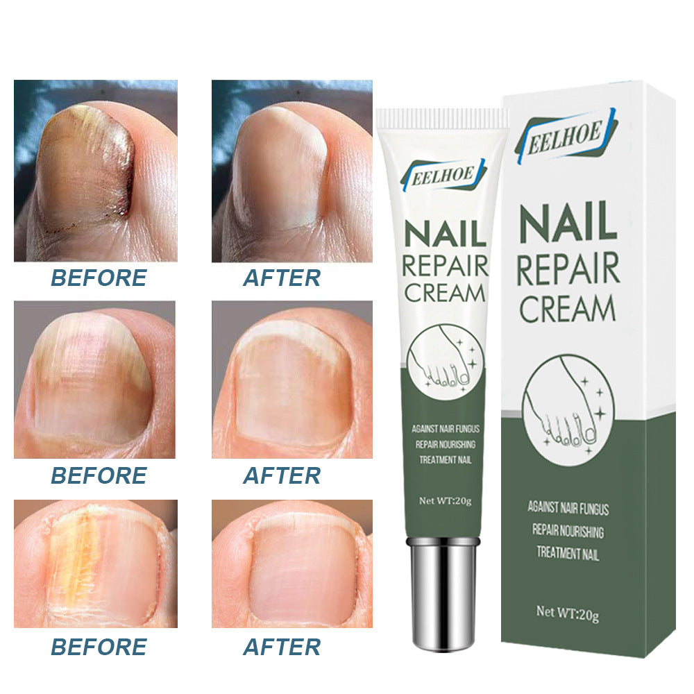 EELHOE nail care cream onychomycosis hand and foot care thickening onychomycosis clean soft nail cream 