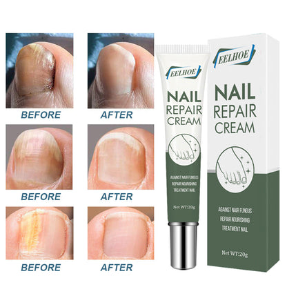 EELHOE Nail Care Cream Onychomycosis Hand and Foot Care Thickening Onychomycosis Soft Nail Cream 